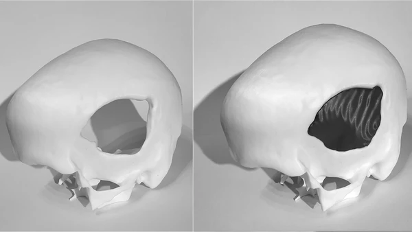 Nowa era w projektowaniu implantów czaszkowych